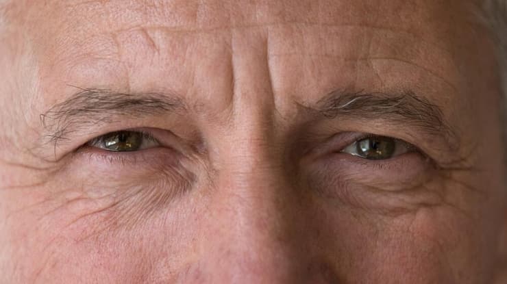 לא רק בעיה אסתטית. עפעפיים צנוחים (צילום: shutterstock) גבר מבוגר עייפות עיניים עפעפיים
