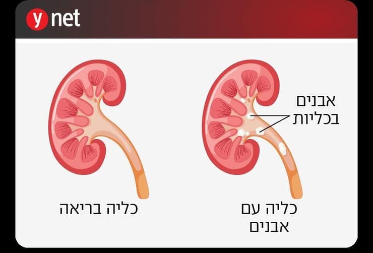 אינפו אבנים בכליות אינפו אבנים בכליות