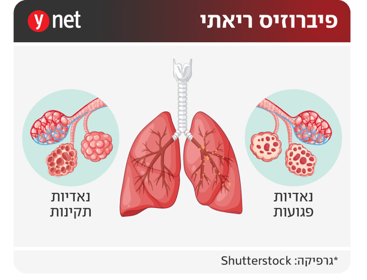 אינפו פיברוזיס ריאתי אינפו פיברוזיס ריאתי