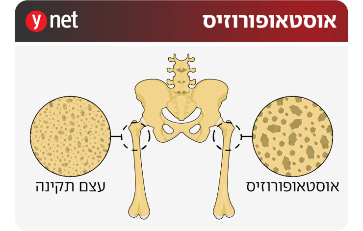 אינפו אוסטאופורוזיס ( גרפיקה: Shutterstock) אינפו אוסטאופורוזיס