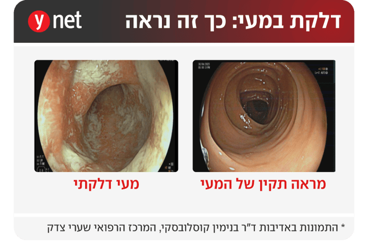 אינפו מחלות מעי דלקתיות קרוהן קוליטיס