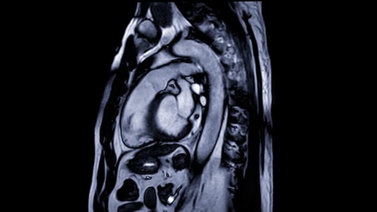 מבט אל הלב בבדיקת MRI (צילום: shutterstock) מבט אל הלב בבדיקת MRI