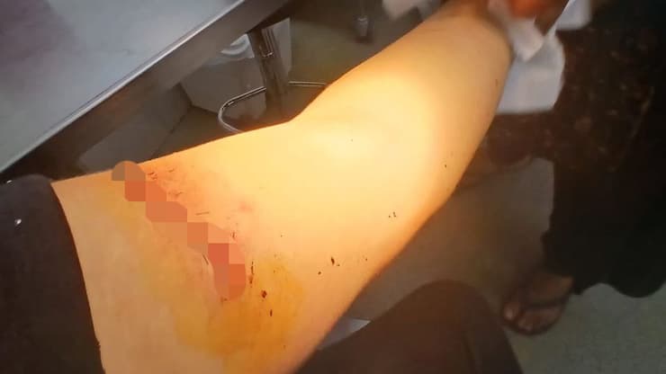 "דקר אותי שלוש פעמים" תושבת המשולש שנדקרה על ידי בן זוגה