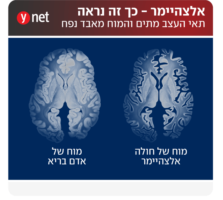 אינפו כך נראה מוח של חולה אלצהיימר (צילום: shutterstock) אינפו כך נראה מוח של חולה אלצהיימר