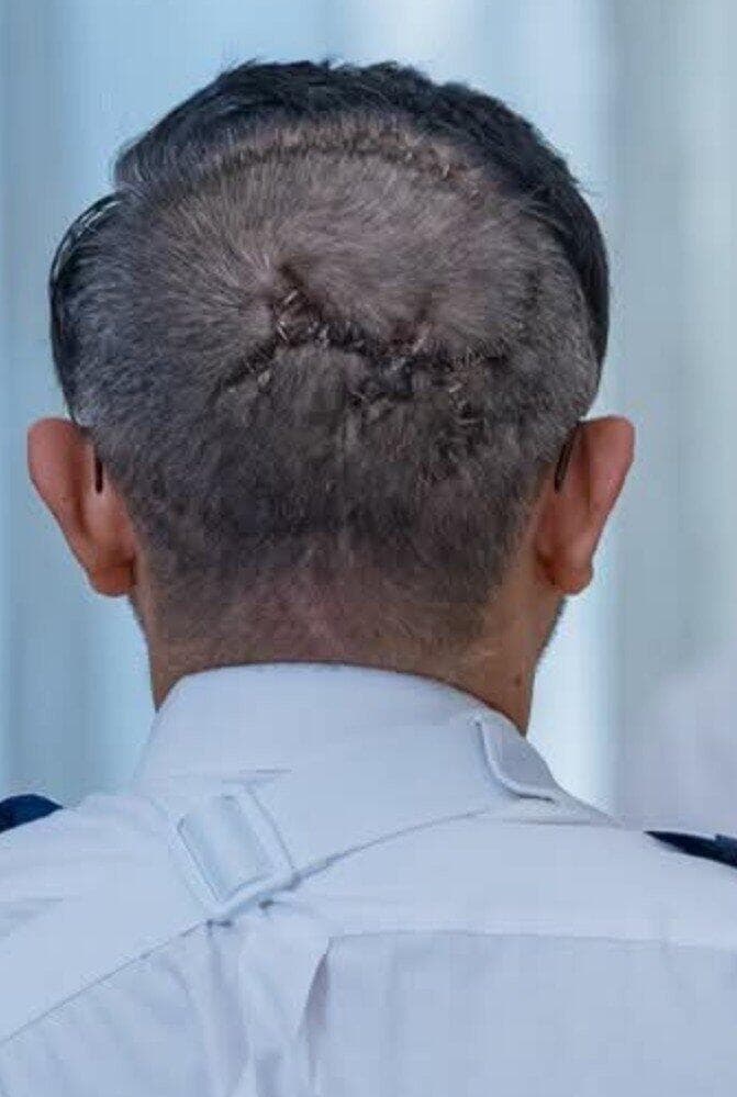 מיקום הפגיעה סמוך לתעלה ורידית מרכזית הופך את הטיפול למורכב במיוחד (צילום: רשת X) סמיט מאצ'הר