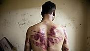 סורי שעבר עינויים בכלא בחלב