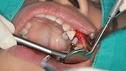 הסיבות להשתלת שיניים