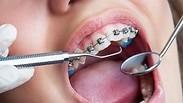 טיפול שיניים בזמן יישור