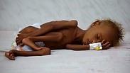 "84,701 ילדים מתחת לגיל 5 מתו מרעב"