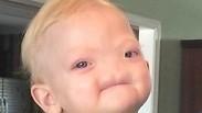 נפטר התינוק שנולד ללא אף