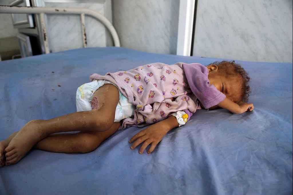 Malnourished child in Yemen