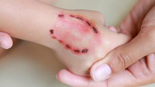 נשיכת כלב. אילוסטרציה