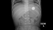 צילום הרנטגן שבוצע בתינוק