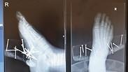צילום רנטגן של רגלו של הילד עם המסמרים