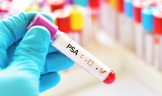 בדיקות ה-PSA: חלק מהנבדקים שנמצאו שליליים - חולים לא מאובחנים