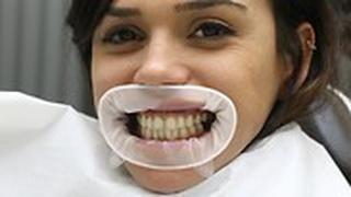 ציפויי שיניים בטורקיה