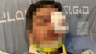 בן 9 מעיסאוויה פונה להדסה עם פגיעה קשה בפניו ובראשו
