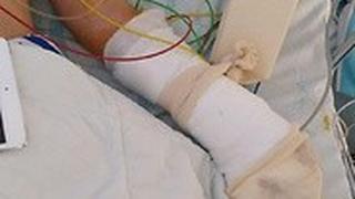 היד החבושה של הילד בבית החולים