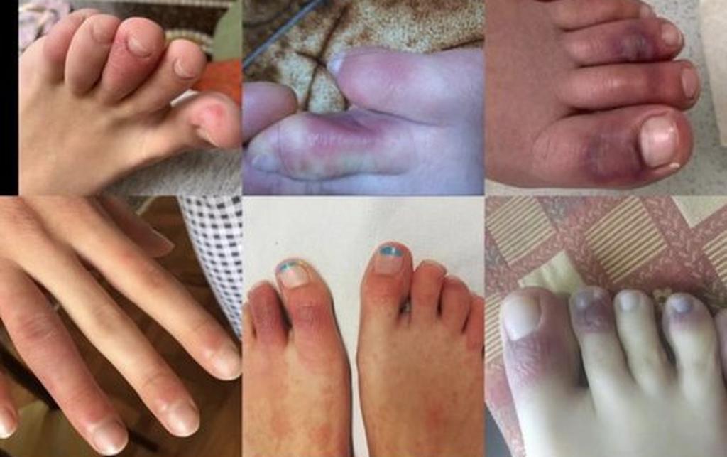 Папулы на пальцах ног, вызванные коронавирусом. Фото со страницы Dawn Wahezi в твиттере