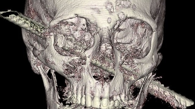 Голова больного со стержнем внутри. Снимок для диагностики: больница "Хадасса" 
