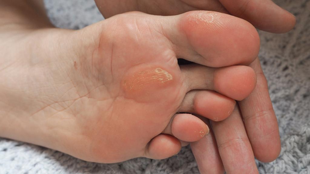 Грибок на ногах, руках, ногтях: симптоматика, причины появления, методы лечения