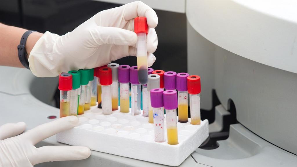 בדיקות דם מחלות מין מעבדה מבחנות 