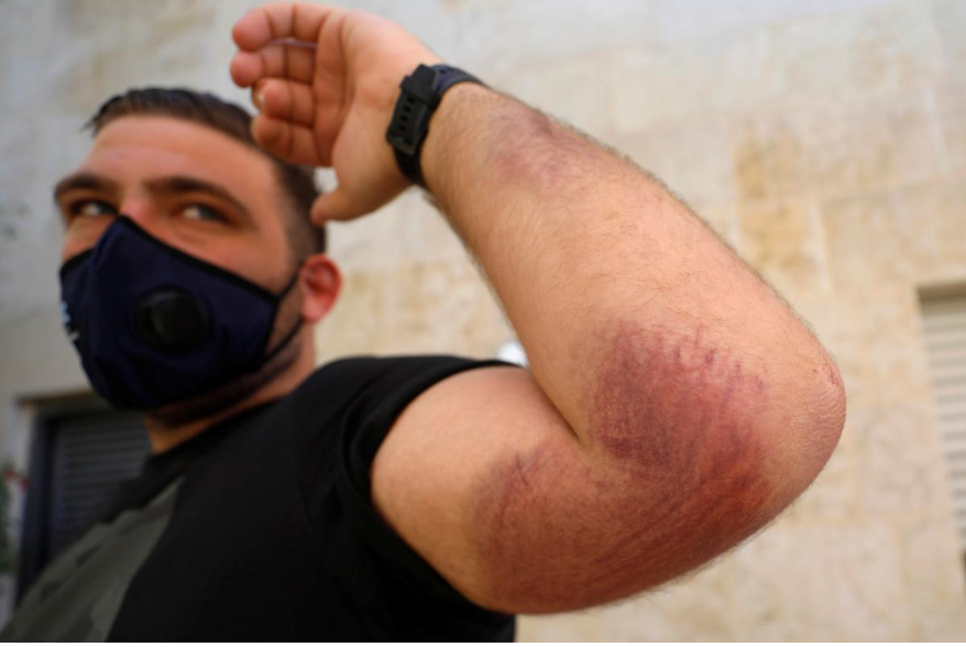Palestinian cyclist Samer Kurdi shows his bruised arm 