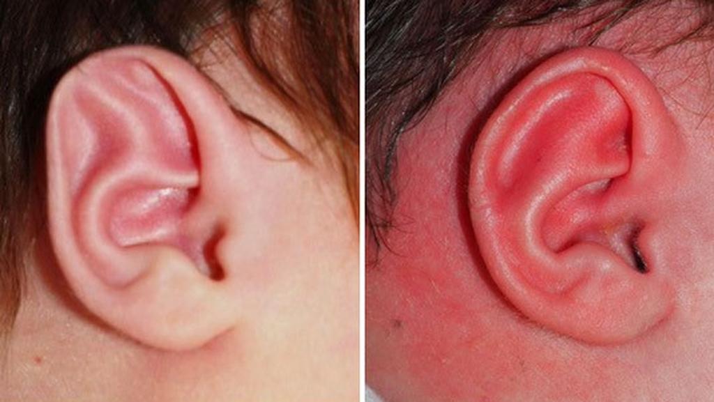 תיקון אוזניים לתינוקות ללא ניתוח
