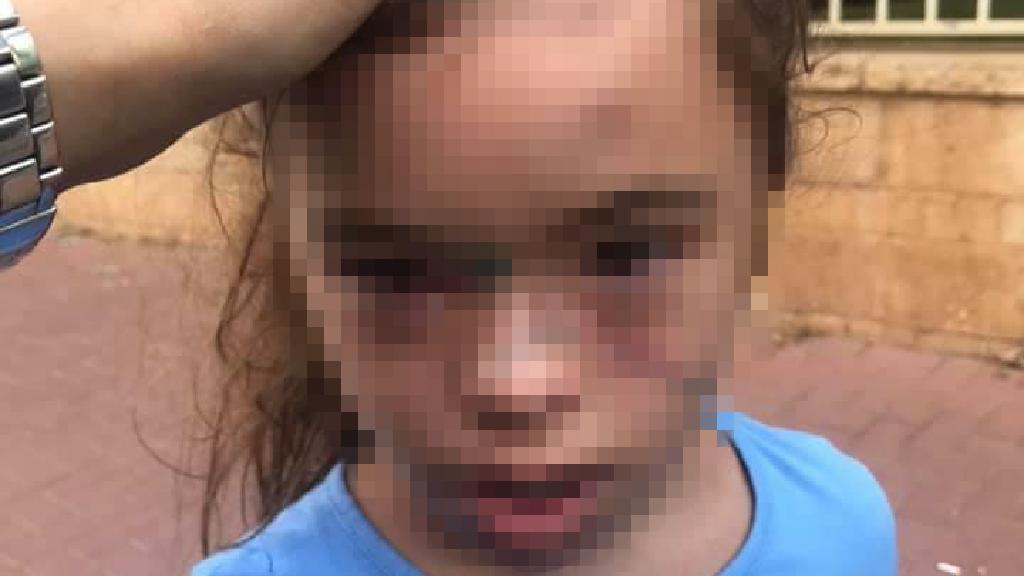 בת 9 עם תסמונת דאון חזרה מבית הספר שהיא פצועה וחבולה. האם "היא כמו אחרי פיגוע!!