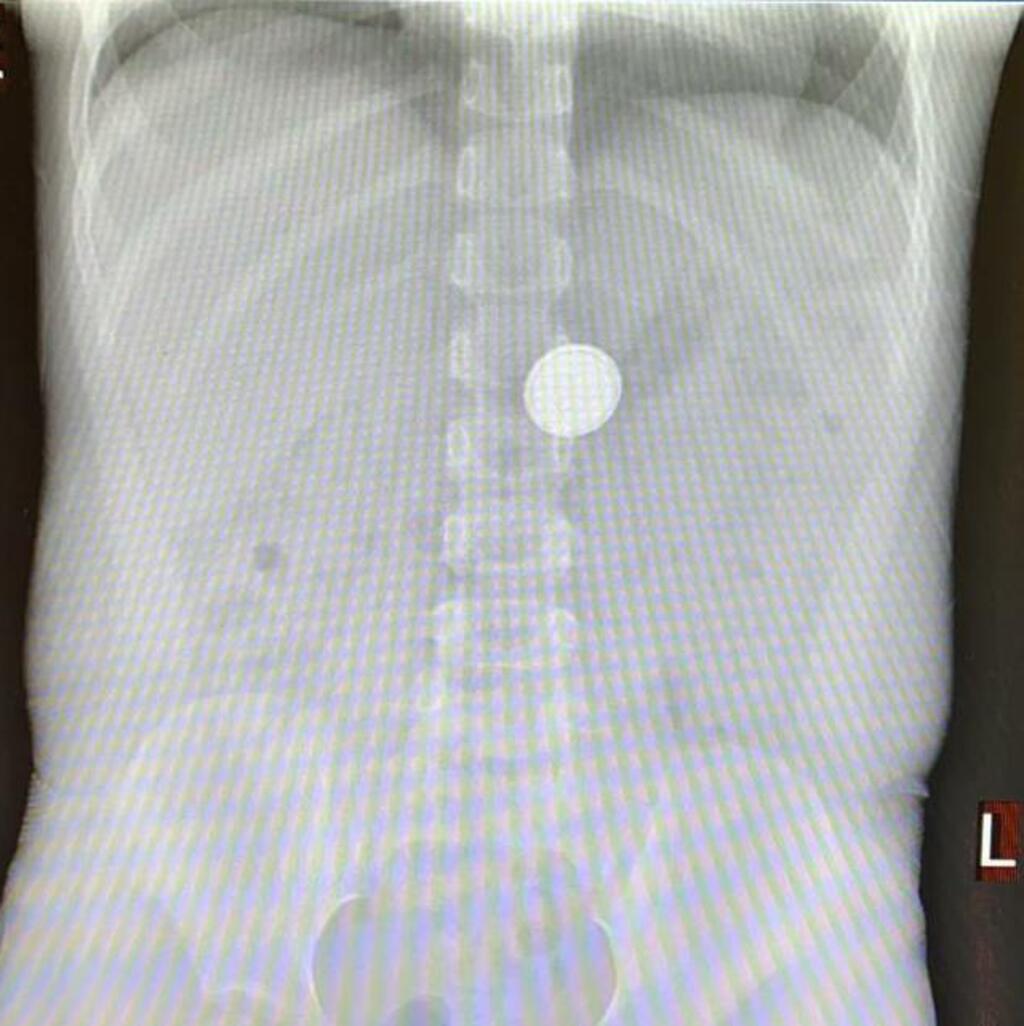 Рентгеновский снимок застрявшей в желудке ребенка батарейки