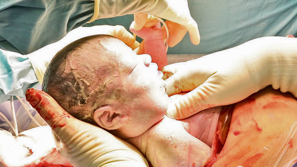 ניתוח נדיר בתינוק באיכילוב