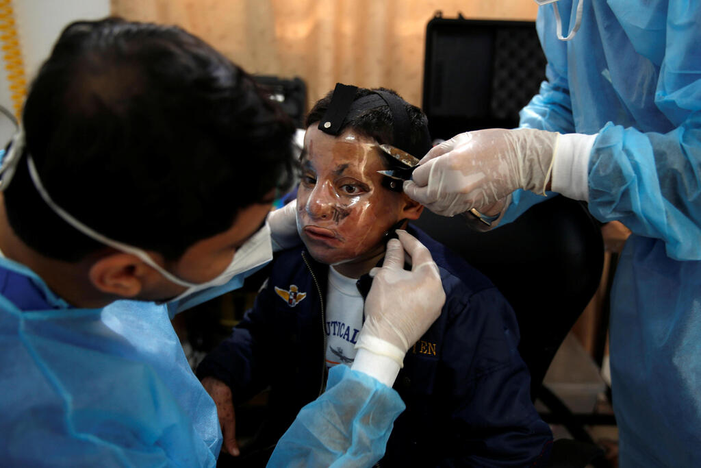 Physiotherapists put a 3D transparent mask on the face of Palestinian boy Ahmed Al-Deeb, who has severe facial burns, at Medecins Sans Frontieres (MSF)'s clinic in Gaza City