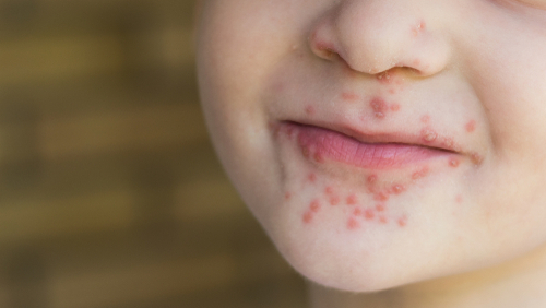 Энтеровирусный везикулярный стоматит (Фото: shutterstock) Энтеровирусный везикулярный стоматит