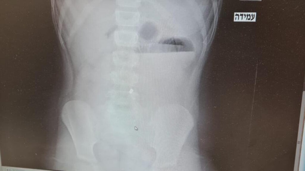 Застрявшие в кишечнике мальчика магниты, рентгеновский снимок (Фото: пресс-служба больницы "Каплан") Застрявшие в кишечнике мальчика магниты, рентгеновский снимок