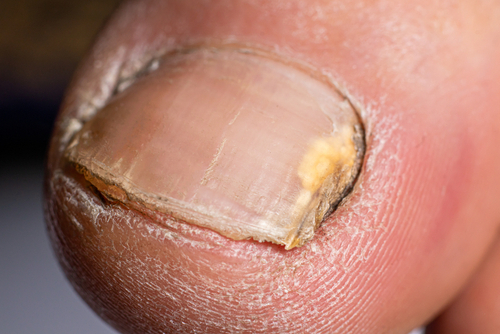 Ногтевой грибок на пальце ноги 