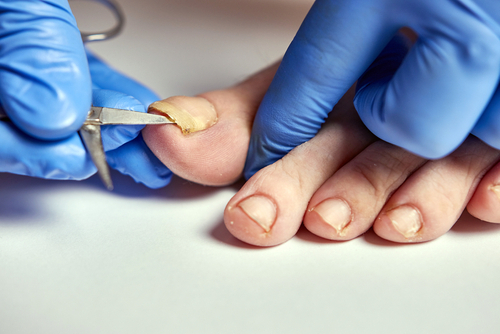 Ногтевой грибок на пальце ноги 