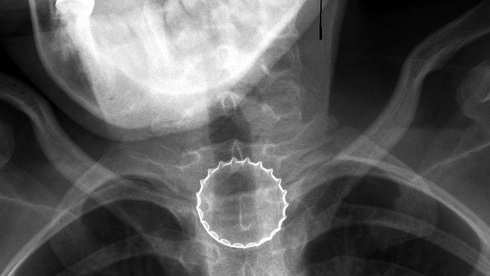  Рентген пищевода с застрявшей пробкой 