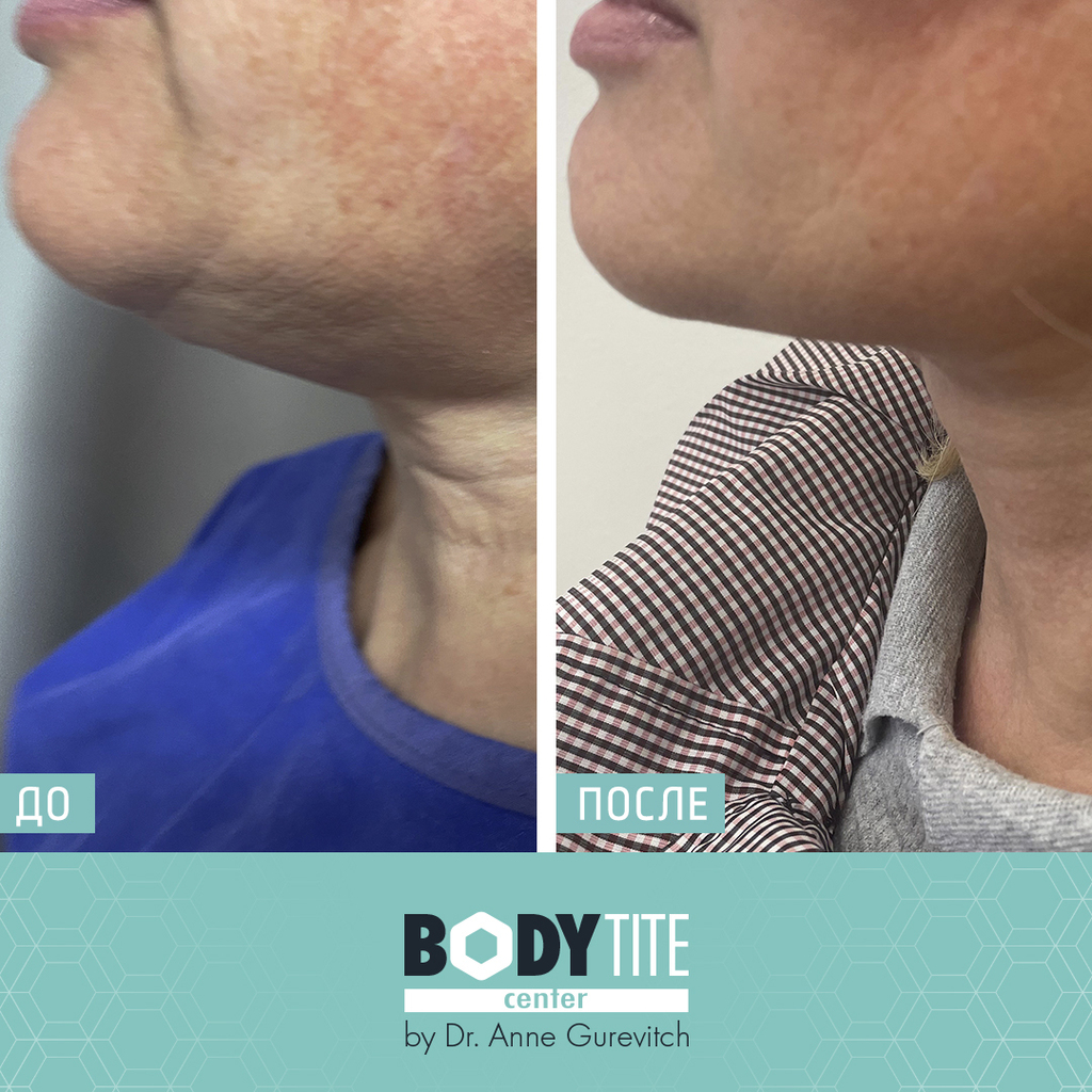 Пациентка центра до и после процедуры подтяжки шеи (Фото предоставлено body tite center) До и после процедуры подтяжки шеи