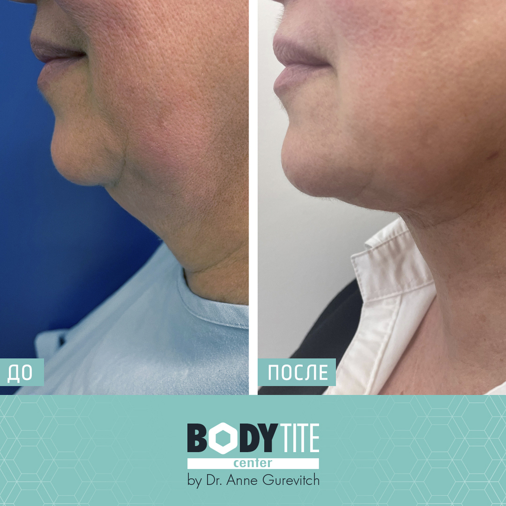 Клиентка клиники до и после процедуры подтяжки шеи (Фото предоставлено body tite center) До и после процедуры подтяжки шеи