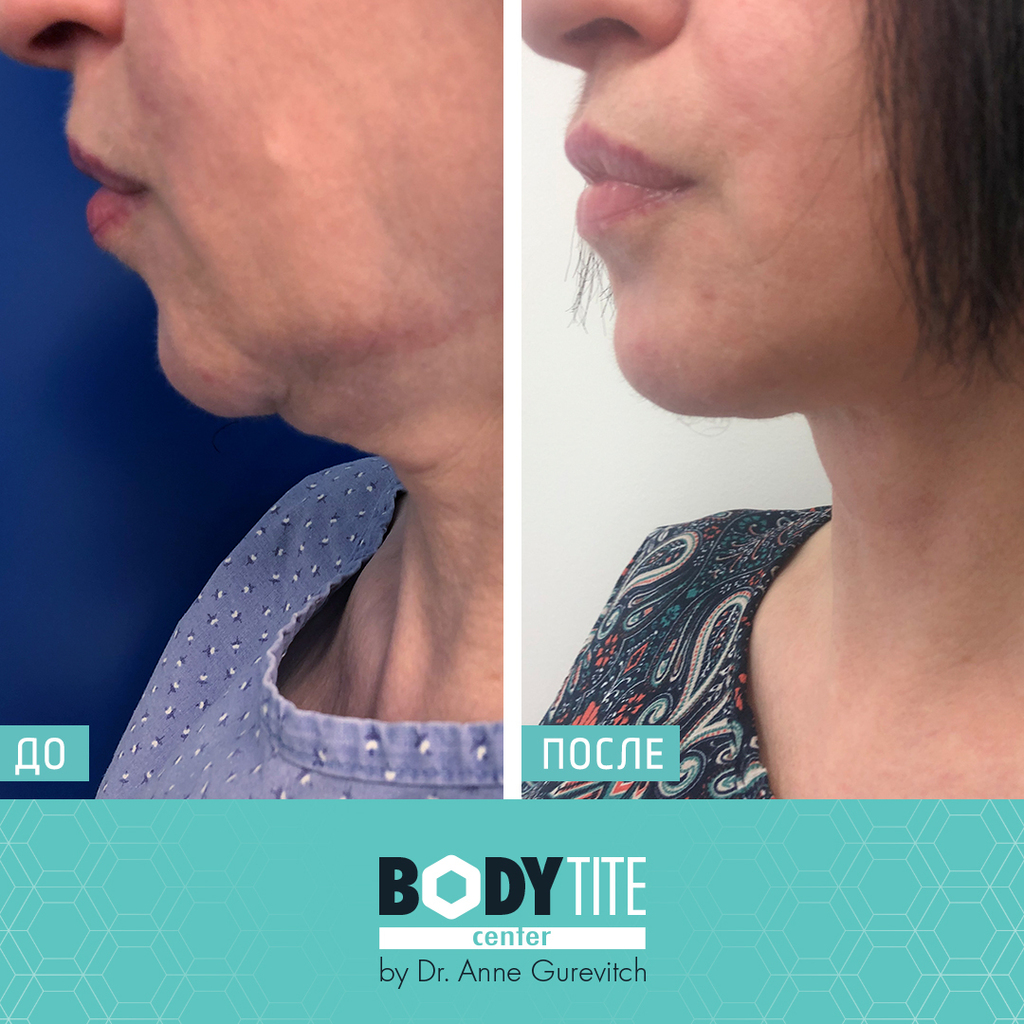 Подтянутый овал лица и скульптурный подбородок - результат процедуры Embrace RF (Фото предоставлено body tite center) До и после процедуры подтяжки шеи
