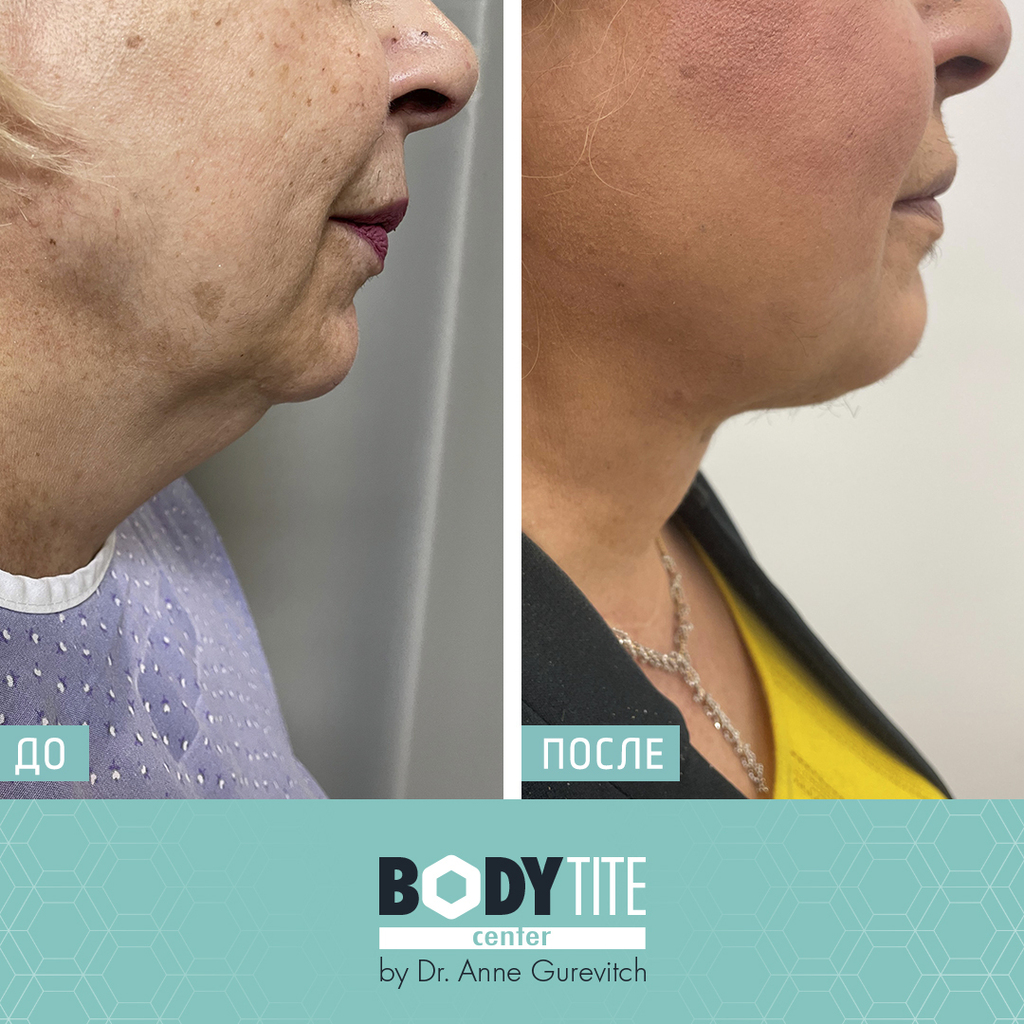 Обвисшей шеи после процедуры больше нет (Фото предоставлено body tite center) До и после процедуры подтяжки шеи