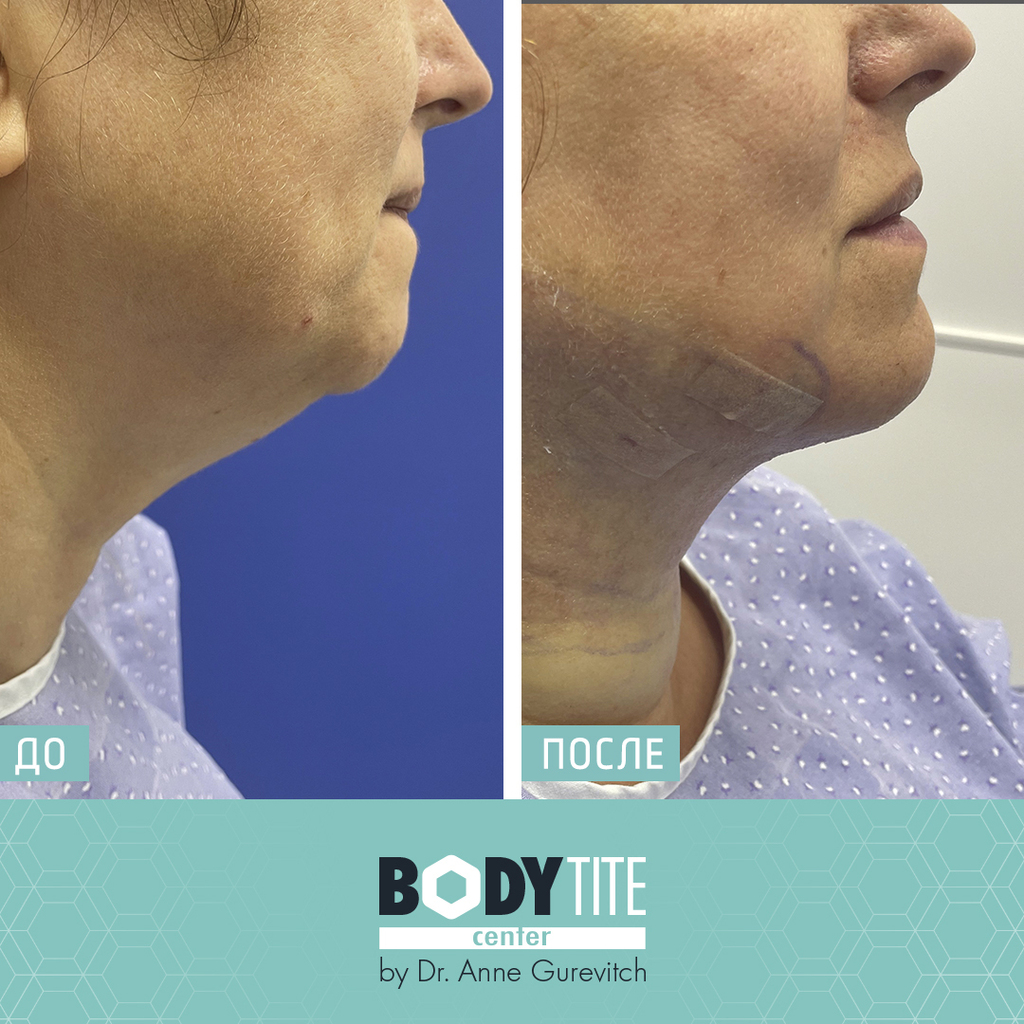 Клиентка до и после процедуры подтяжки шеи, фото "после" сделано в операционной сразу после процедуры (Фото предоставлено body tite center) До и после процедуры подтяжки шеи