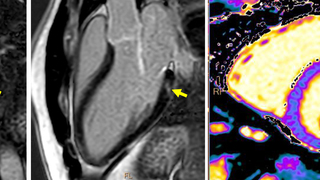 MRI  אחרי חיסון קורונה