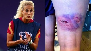 רגלה של חמראווי אחרי התקיפה