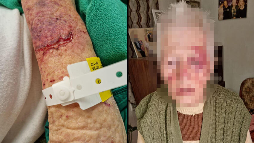 Грабители жестоко избили 92-летнюю пережившую Холокост (Фото предоставлено семьей потерпевшей) הקשישה לאחר התקיפה