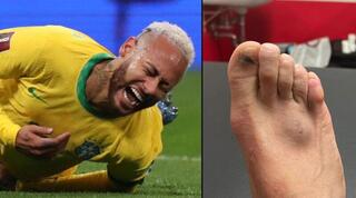 הרגל של ניימאר אחרי הפגיעה