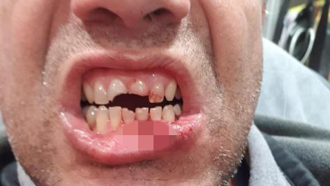 Гай Эфрон после нападения גיא עברון, המפגין שנפצע בירושלים