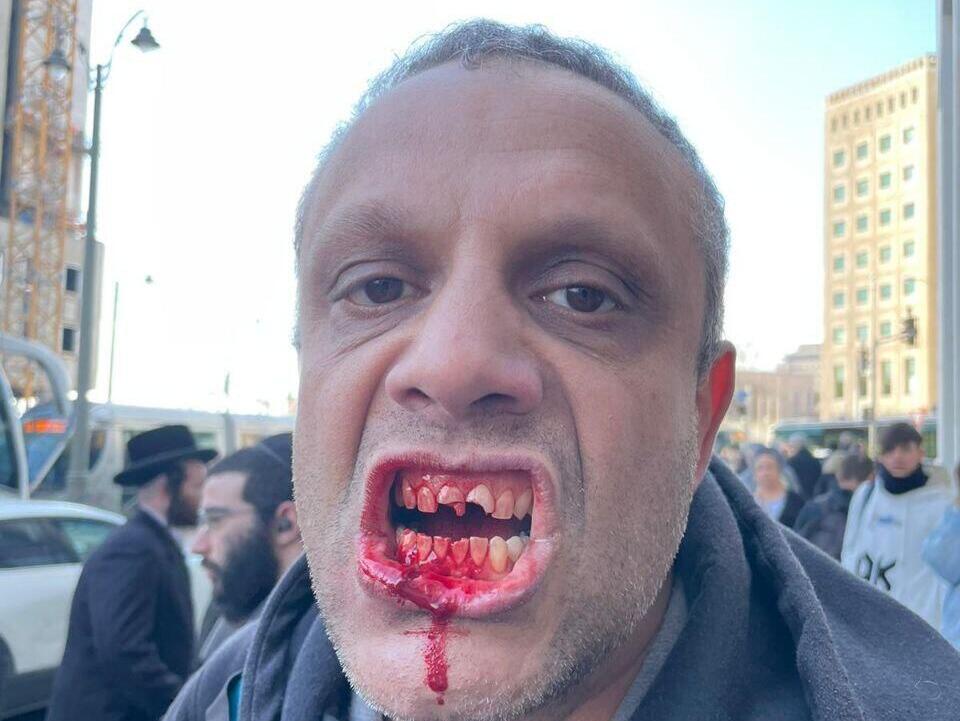 Гай Эврон המפגין גיא עברון שהותקף בהפגנה