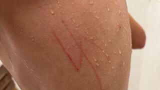 צלב קרס שנחרט על גבו של ילד בלאס וגאס