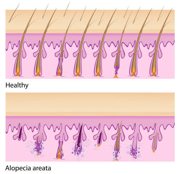 Healthy hair follicles (upper panel) and hair follicles damaged by alopecia areata (lower panel)